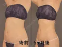 胸下+腹部全体+腰 after画像 サムネイル用