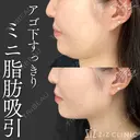 【小顔整形】ミニ脂肪吸引(顎下中央、サイド) after画像 サムネイル用