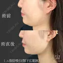 【小顔整形】ミニ脂肪吸引(顎下中央、サイド) before画像 サムネイル用
