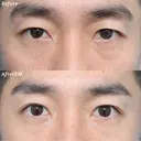埋没4点留め｜埋没でお目元はっきりとした印象に before画像 サムネイル用