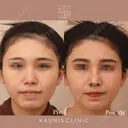 鼻中隔延長、隆鼻 after画像 サムネイル用