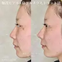 加賀ヒアル×鼻先コルメラストラット法 before画像 サムネイル用