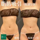 コンプリート脂肪吸引(上下腹部・ウエスト・腰 after画像 サムネイル用