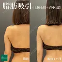 コンプリート脂肪吸引【上腕全周〜背中の一部】 after画像 サムネイル用