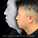顎のヒアルロン酸 before画像 サムネイル用