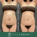 コンプリート脂肪吸引(上下腹部・ウエスト・腰) after画像 サムネイル用