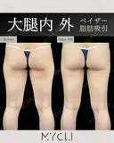 ベイザー脂肪吸引（大腿内・外） after画像 サムネイル用