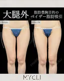 脂肪豊胸目的のベイザー脂肪吸引（大腿外） after画像 サムネイル用