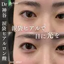 涙袋ヒアルロン酸 before画像 サムネイル用