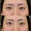 涙袋ヒアルロン酸 after画像 サムネイル用