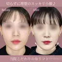 リフト after画像 サムネイル用