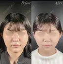 小顔整形－複合－ after画像 サムネイル用