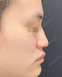 プロテーゼ・鼻尖形成・小鼻縮小 before画像 サムネイル用