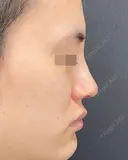 プロテーゼ・鼻尖形成・小鼻縮小 7日後 サムネイル用
