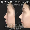 他院鼻プロテーゼ入替＋鼻フルコース［クローズ法］（鼻複合自家組織移植術）＋鼻骨骨切り幅寄せ術＋貴族手術 before画像 サムネイル用