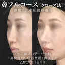 他院鼻プロテーゼ入替＋鼻フルコース［クローズ法］（鼻複合自家組織移植術）＋鼻骨骨切り幅寄せ術＋貴族手術 after画像 サムネイル用