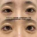 外科的涙袋形成と、たれ目形成の関係性 after画像 サムネイル用