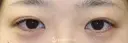 【20代女性・平行型の二重で美人目に】目頭切開（術後3ヶ月） before画像 サムネイル用