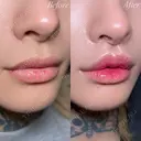 口唇整形－複合－ before画像 サムネイル用