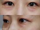 【30代女性・目の下のクマとたるみの改善】プレミアムPRP皮膚再生療法（2ヶ月後） before画像 サムネイル用