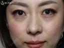 【40の女性・目の下のクマ、たるみ、段差】目の下+法令線のプレミアムPRP（7ヶ月後） before画像 サムネイル用