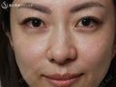 【40の女性・目の下のクマ、たるみ、段差】目の下+法令線のプレミアムPRP（7ヶ月後） 210日後 サムネイル用