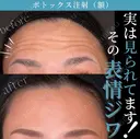ボトックスビスタ 額　8単位　 before画像 サムネイル用