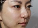 【40の女性・目の下のクマ、たるみ、段差】目の下+法令線のプレミアムPRP（7ヶ月後） after画像 サムネイル用