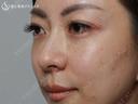 【40の女性・目の下のクマ、たるみ、段差】目の下+法令線のプレミアムPRP（7ヶ月後） after画像 サムネイル用