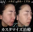 カスタマイズ治療　3回 before画像 サムネイル用