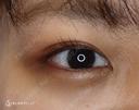 【20代女性・ナチュラルな二重に！！】マイクロメソッド＋α（1ヶ月後） 30日後 サムネイル用
