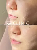 人中短縮レーザー before画像 サムネイル用