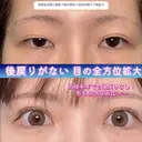 全方位拡大術〜全切開二重術（他院修正）＋目尻切開＋眼瞼下垂単独（他院修正） 120日後 サムネイル用