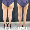 太もも脂肪吸引 after画像 サムネイル用