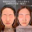小顔複合〜顔脂肪吸引＋脂肪注入＋糸リフト 180日後 サムネイル用