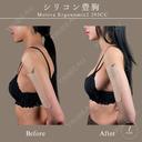 モディバ　シリコンバッグ豊胸 after画像 サムネイル用