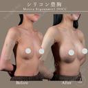 モディバ　シリコンバッグ豊胸 after画像 サムネイル用