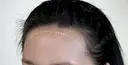 アートメイクヘアライン before画像 サムネイル用