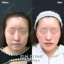 小顔治療（糸リフト、ヒアルロン酸、ボトックス） before画像 サムネイル用
