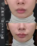 唇ヒアルロン酸 before画像 サムネイル用