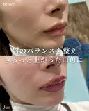 唇ヒアルロン酸 after画像 サムネイル用