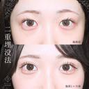 選べるオーダメイド二重埋没法 after画像 サムネイル用
