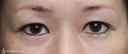 【40代女性・二重幅を拡げたい】眉下切開＋埋没法（左１点）（眉下切開抜糸時に埋没法） before画像 サムネイル用