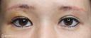【40代女性・二重幅を拡げたい】眉下切開＋埋没法（左１点）（眉下切開抜糸時に埋没法） 6日後 サムネイル用