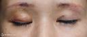 【40代女性・二重幅を拡げたい】眉下切開＋埋没法（左１点）（眉下切開抜糸時に埋没法） 6日後 サムネイル用