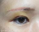 【40代女性・二重幅を拡げたい】眉下切開＋埋没法（左１点）（眉下切開抜糸時に埋没法） 6日後 サムネイル用