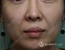 【女性・ほうれい線、たるみ改善後２年経過】プレミアムPRP皮膚再生療法（２年後） before画像 サムネイル用