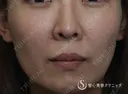 【女性・ほうれい線、たるみ改善後２年経過】プレミアムPRP皮膚再生療法（２年後） 730日後 サムネイル用