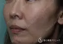 【女性・ほうれい線、たるみ改善後２年経過】プレミアムPRP皮膚再生療法（２年後） 730日後 サムネイル用