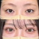 ネクサスアイズ(埋没法) before画像 サムネイル用